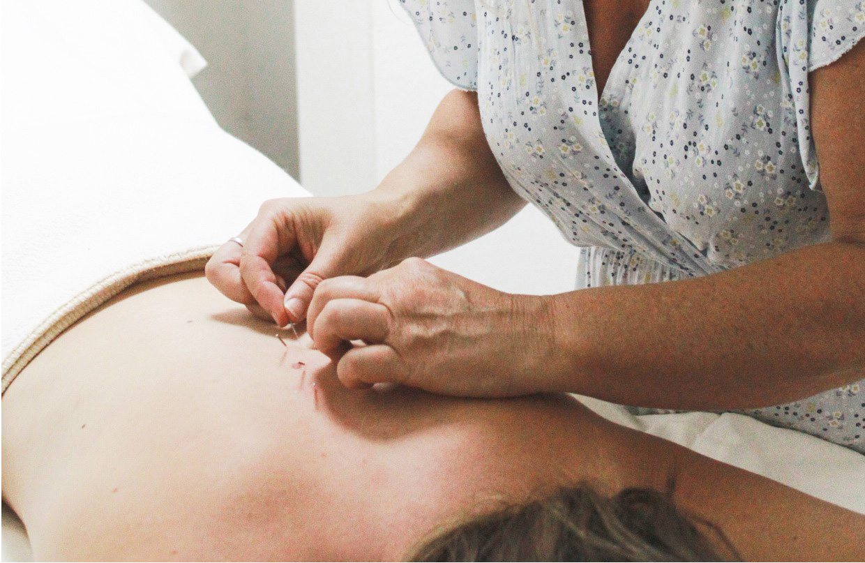 Traditional Chinese Acupuncture treatment